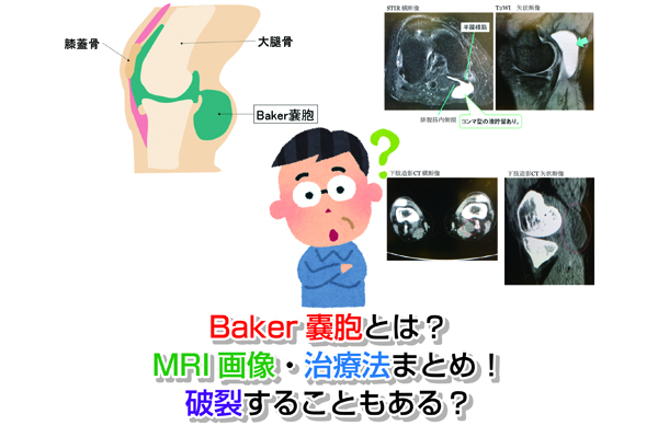 Baker嚢胞とは？MRI画像・治療法まとめ！破裂することもある？