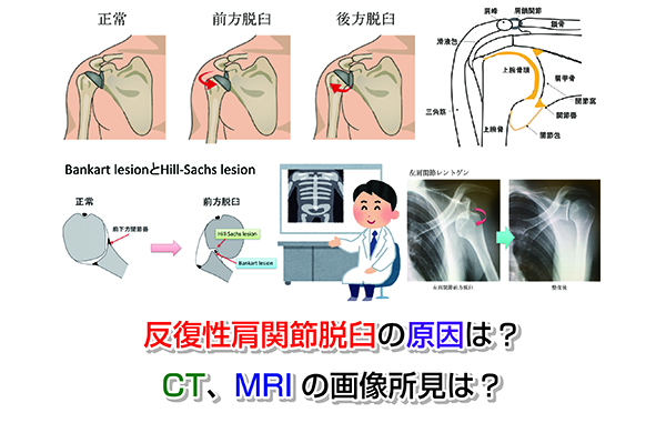 反復性肩関節脱臼の原因は？CT、MRIの画像所見は？