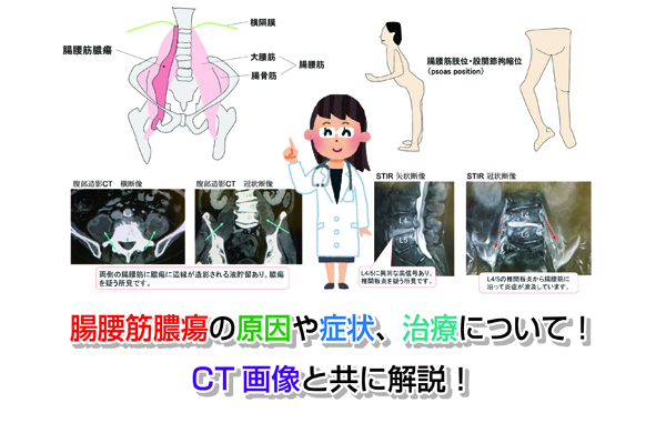 腸腰筋膿瘍の原因や症状、治療について！CT画像と共に解説！