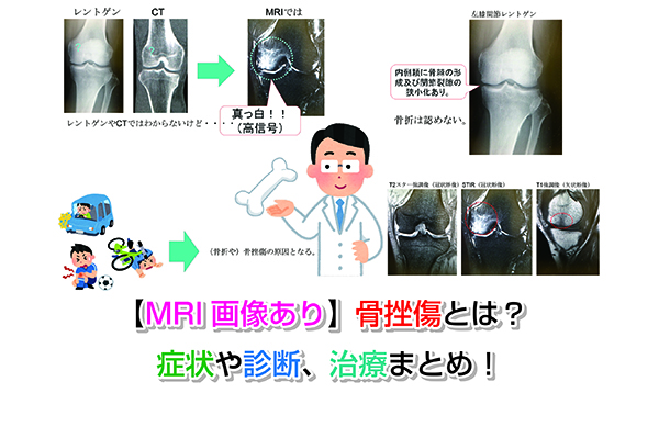 【MRI画像あり】大腿骨頭壊死とは？症状や原因、治療法を説明！