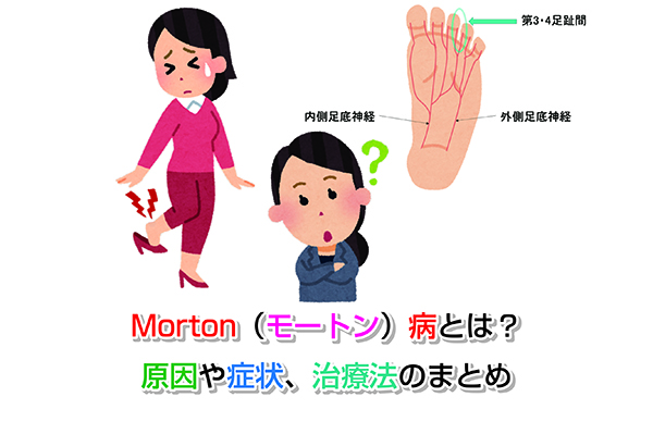 Morton（モートン）病とは？原因や症状、治療法のまとめ