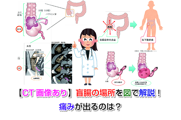 【CT画像あり】盲腸の場所を図で解説！痛みが出るのは？