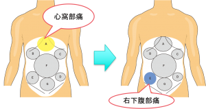 「金的の痛み」「盲腸」は本当か？生理痛を男性の痛みに例える最新議論と、2026年の「痛み格差」解消への道