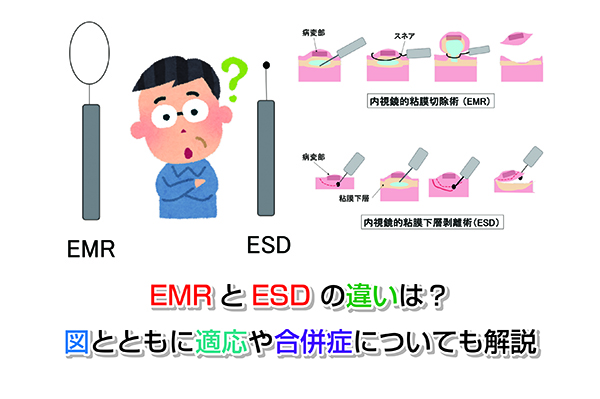 EMRとESD の違いは？図とともに適応や合併症についても解説