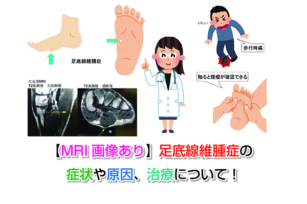【MRI画像あり】足底線維腫症の症状や原因、治療について！