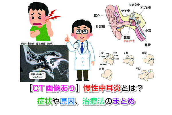 【CT画像あり】慢性中耳炎とは？症状や原因、治療法のまとめ