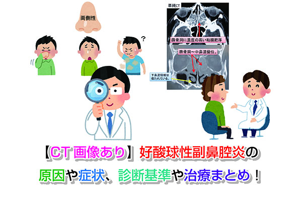 【CT画像あり】好酸球性副鼻腔炎の原因や症状、診断基準や治療まとめ！