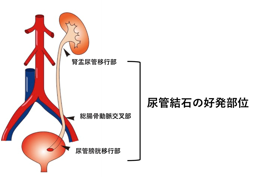 尿管の生理的狭窄部位・尿管結石の好発部位
