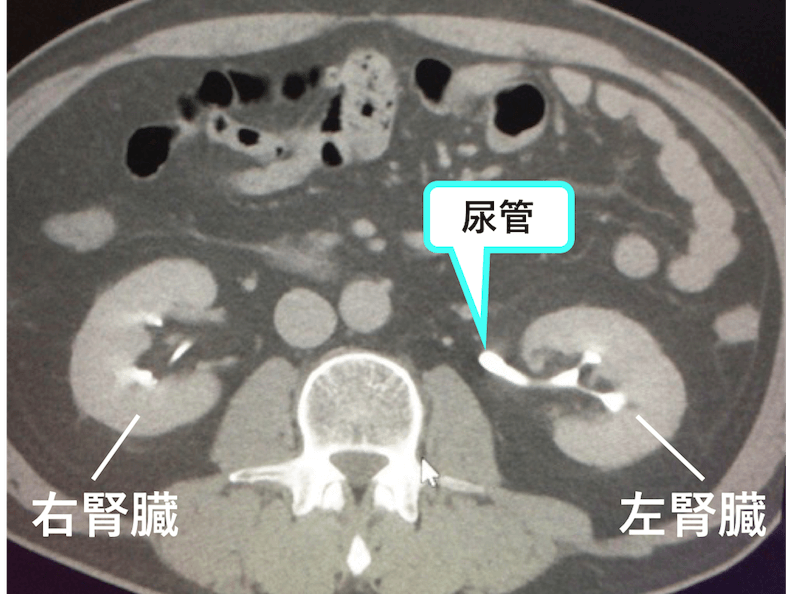 尿管のCT画像　腎盂付近