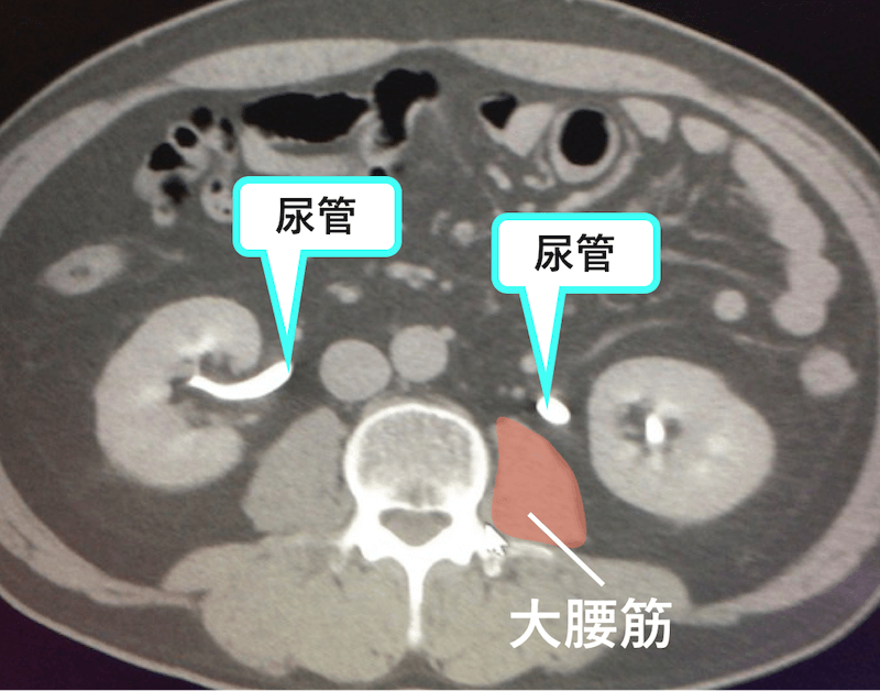 尿管のCT画像　腎盂付近