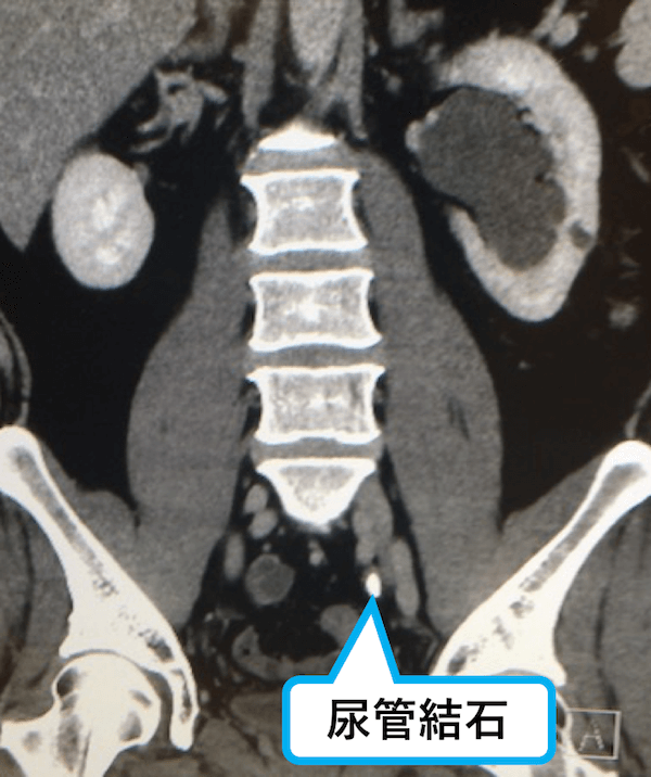 尿管結石による水腎症のCT画像