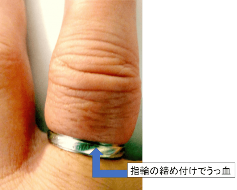 【図解】うっ血と充血の違いは?意味や原因について解説