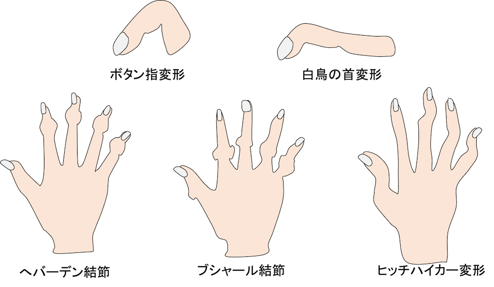 指の変形
