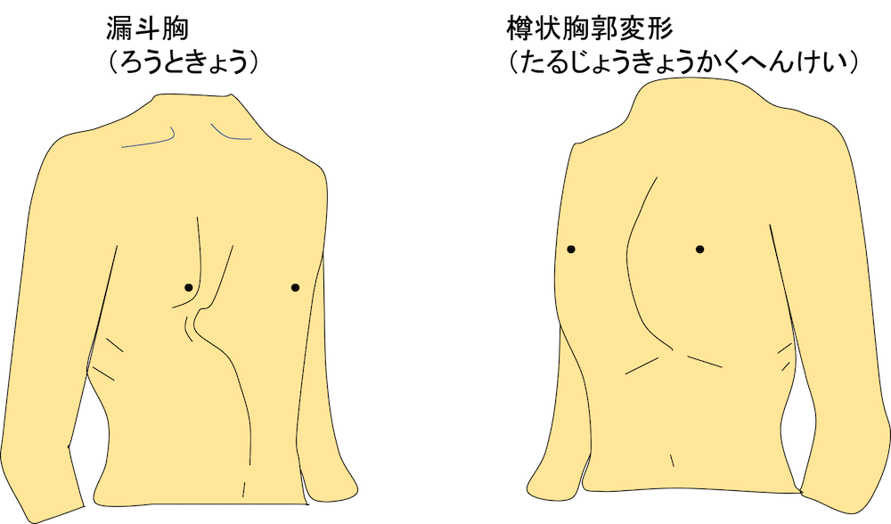 胸郭の変形