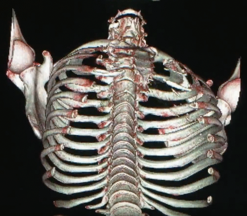 胸郭下口の3DCT画像