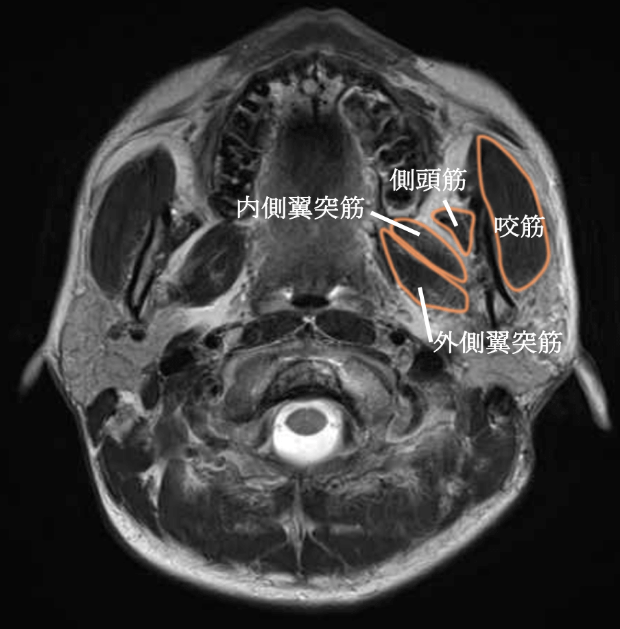 咀嚼筋のMRI画像における解剖・場所