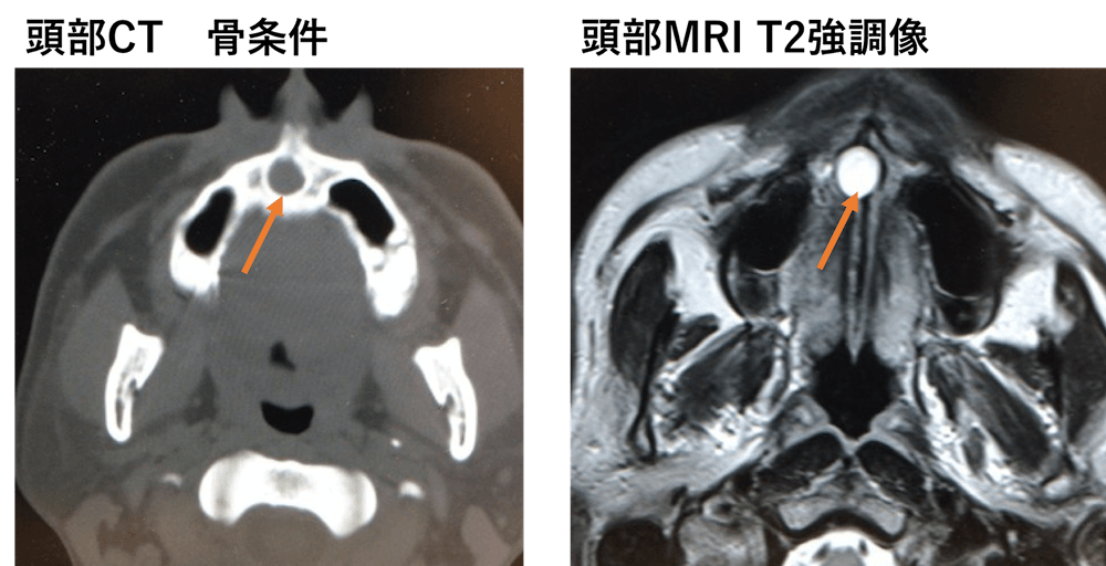 切歯管嚢胞のCT画像MRI画像