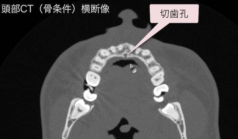 切歯管・切歯孔のCT画像