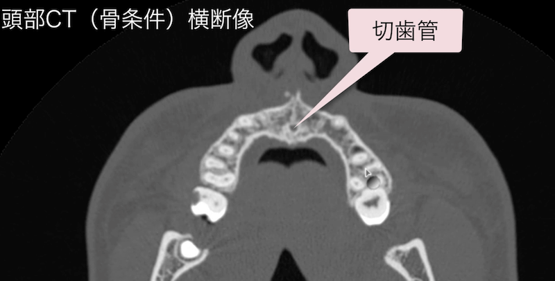 切歯管・切歯孔のCT画像