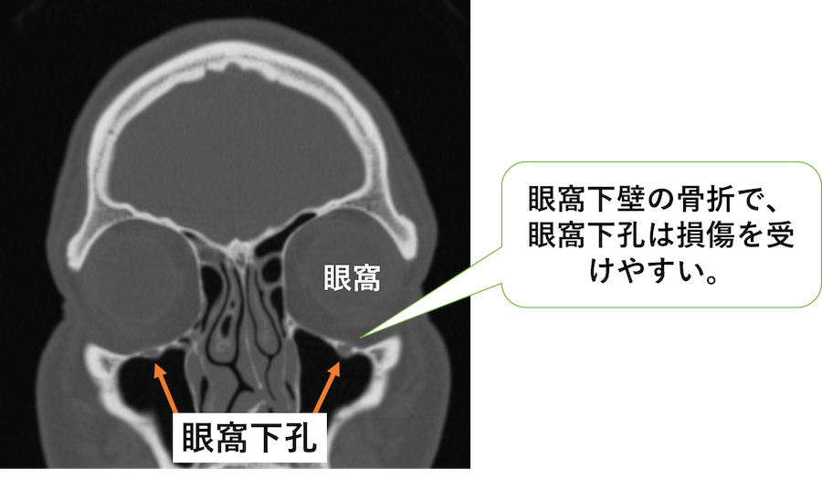 眼窩下孔の冠状断像のCT画像