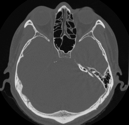 上眼窩裂（superior orbital fissure）のCT画像における解剖