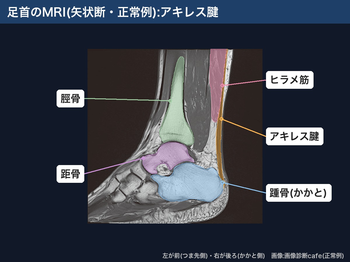 足首のMRI(矢状断・画像診断cafe正常例):アキレス腱・ヒラメ筋・踵骨・脛骨・距骨