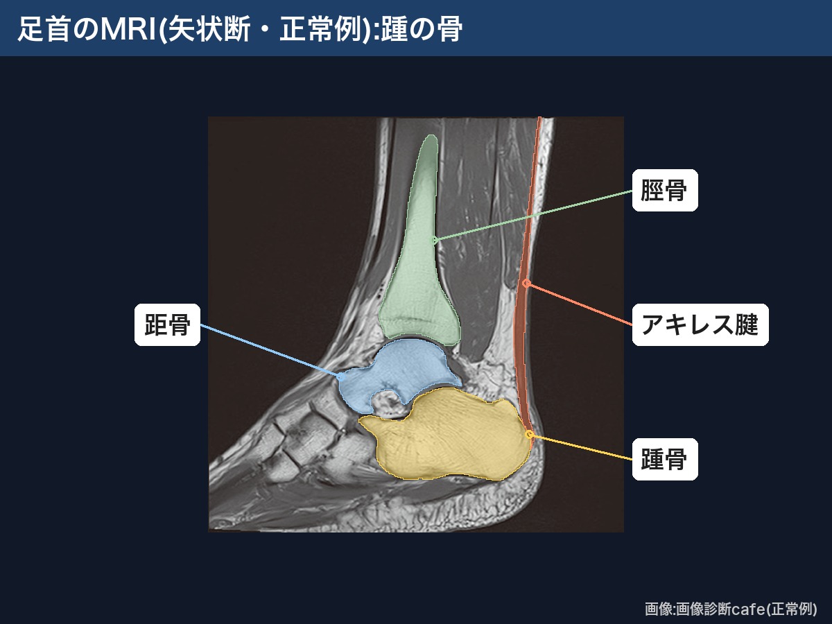 足首のMRI(矢状断・正常例):踵骨・距骨・アキレス腱・脛骨