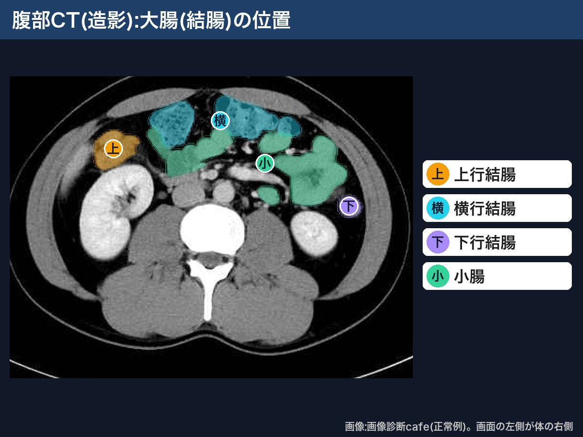 腹部CT(造影・画像診断cafe正常例):上行結腸・横行結腸・下行結腸・小腸
