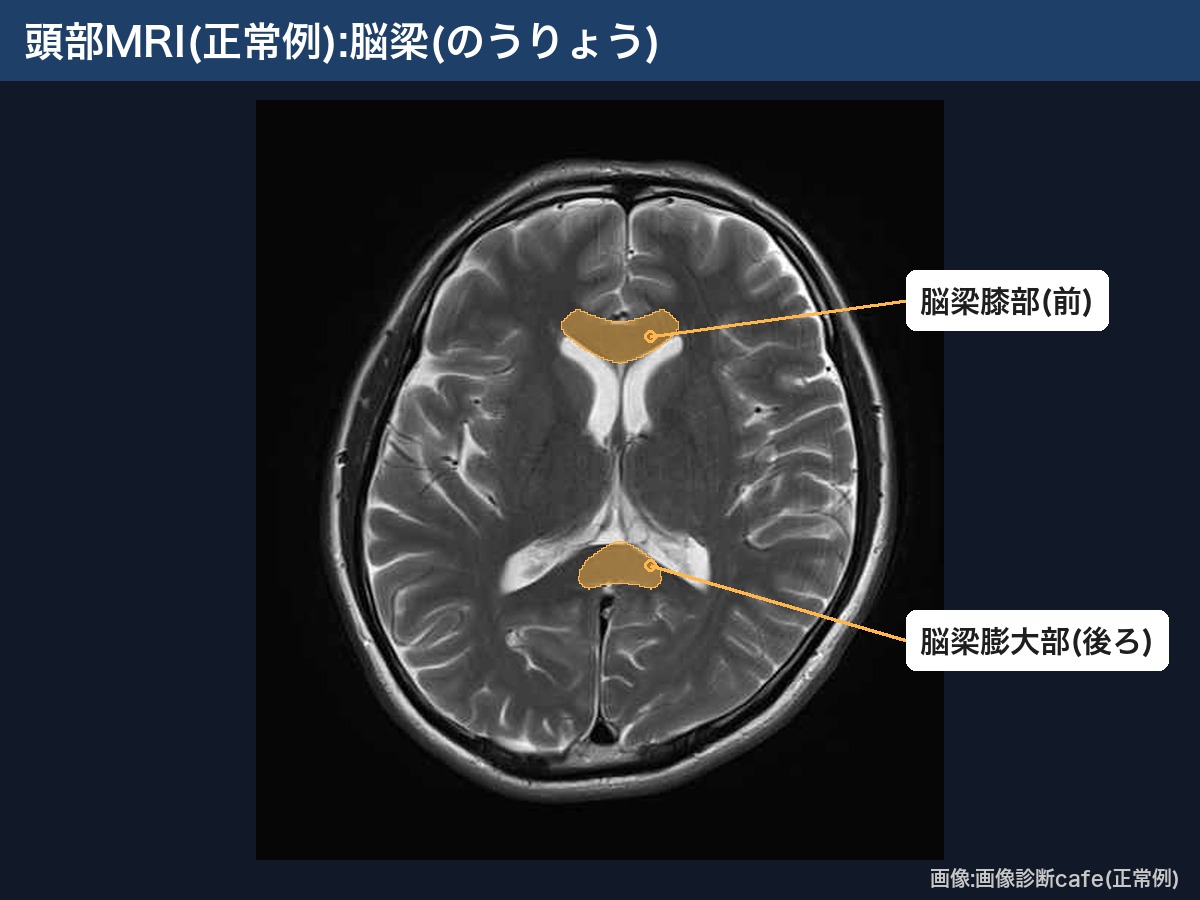 頭部MRI(画像診断cafe正常例):脳梁の膝部と膨大部