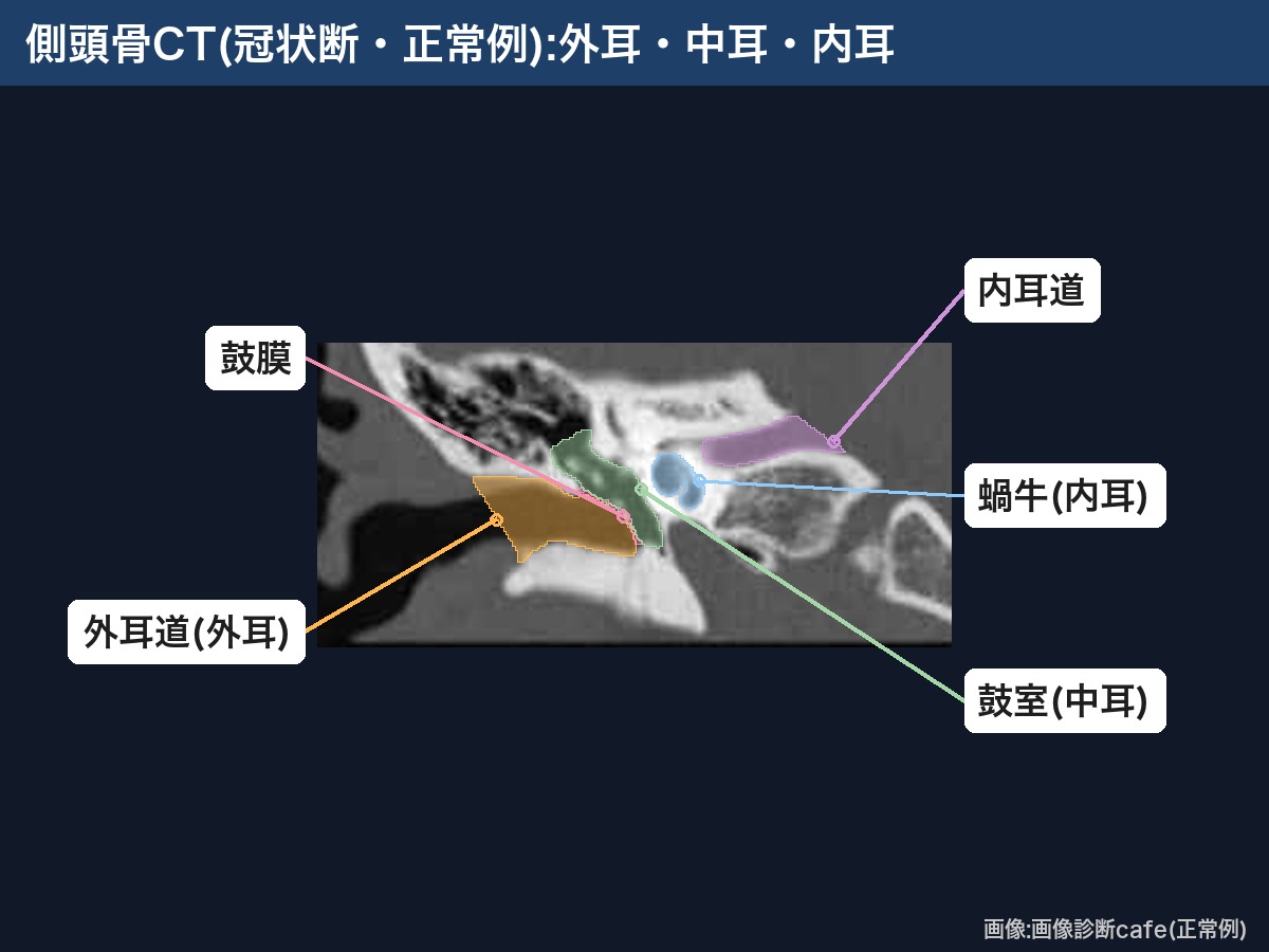 側頭骨CT(冠状断・画像診断cafe正常例):外耳道・鼓膜・鼓室・蝸牛・内耳道