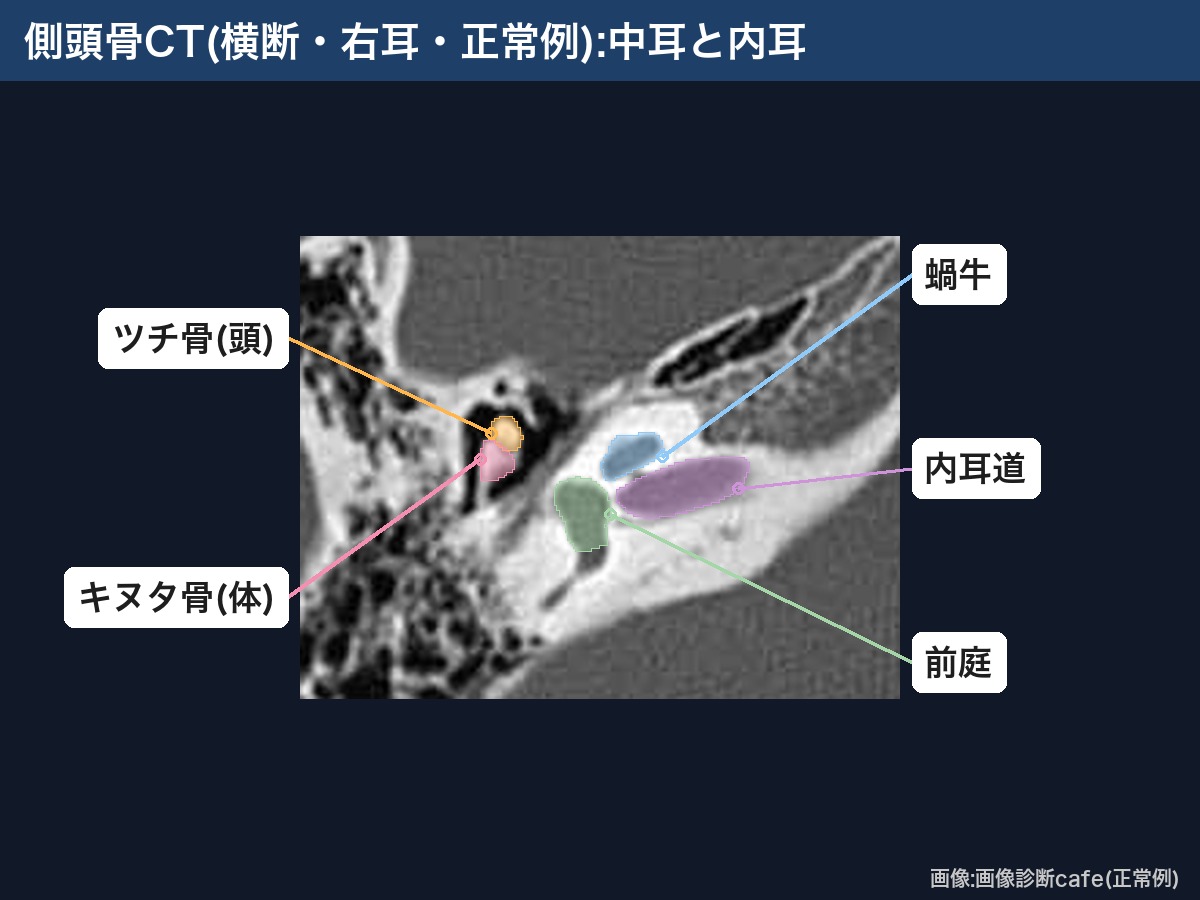 側頭骨CT(横断・右耳・画像診断cafe正常例):ツチ骨・キヌタ骨・前庭・蝸牛・内耳道