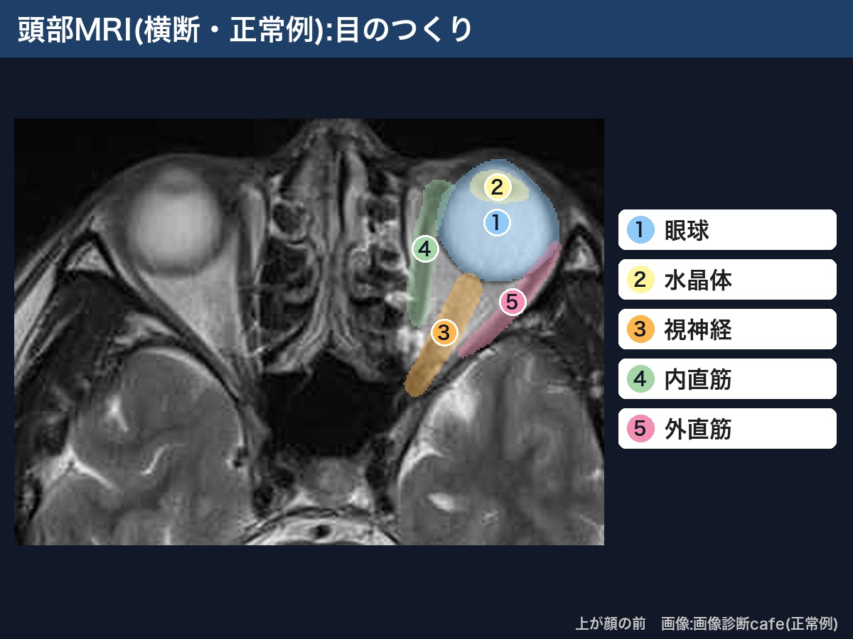 頭部MRI(横断・画像診断cafe正常例):眼球・水晶体・視神経・内直筋・外直筋
