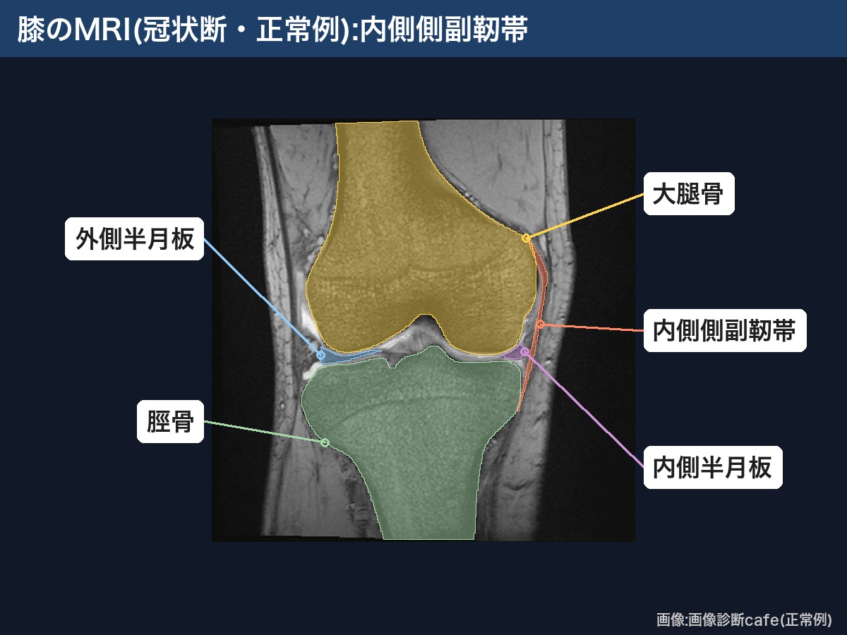 膝のMRI(冠状断・正常例):内側側副靭帯・内側半月板・大腿骨・脛骨