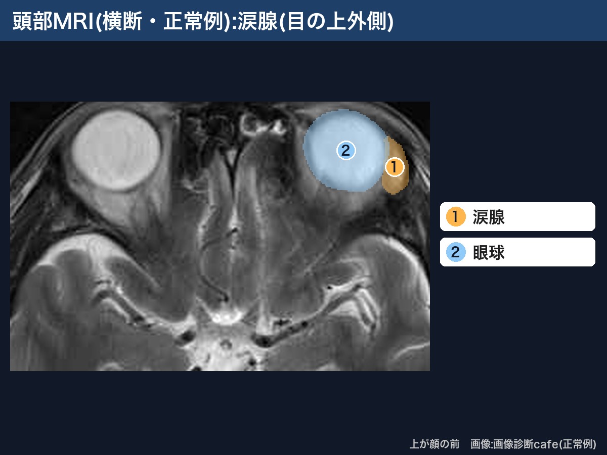 頭部MRI(横断・画像診断cafe正常例):涙腺と眼球