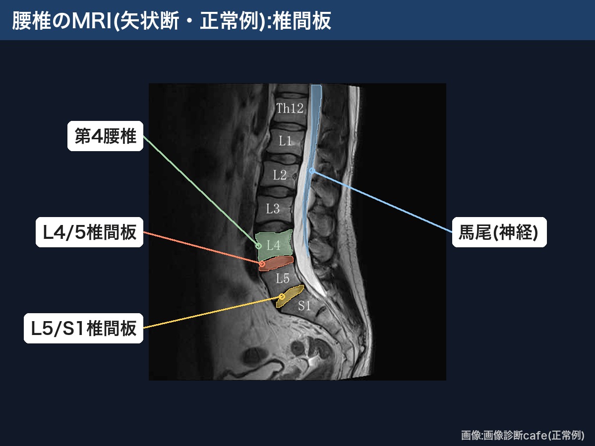 腰椎のMRI(矢状断・正常例):L4/5・L5/S1椎間板と馬尾