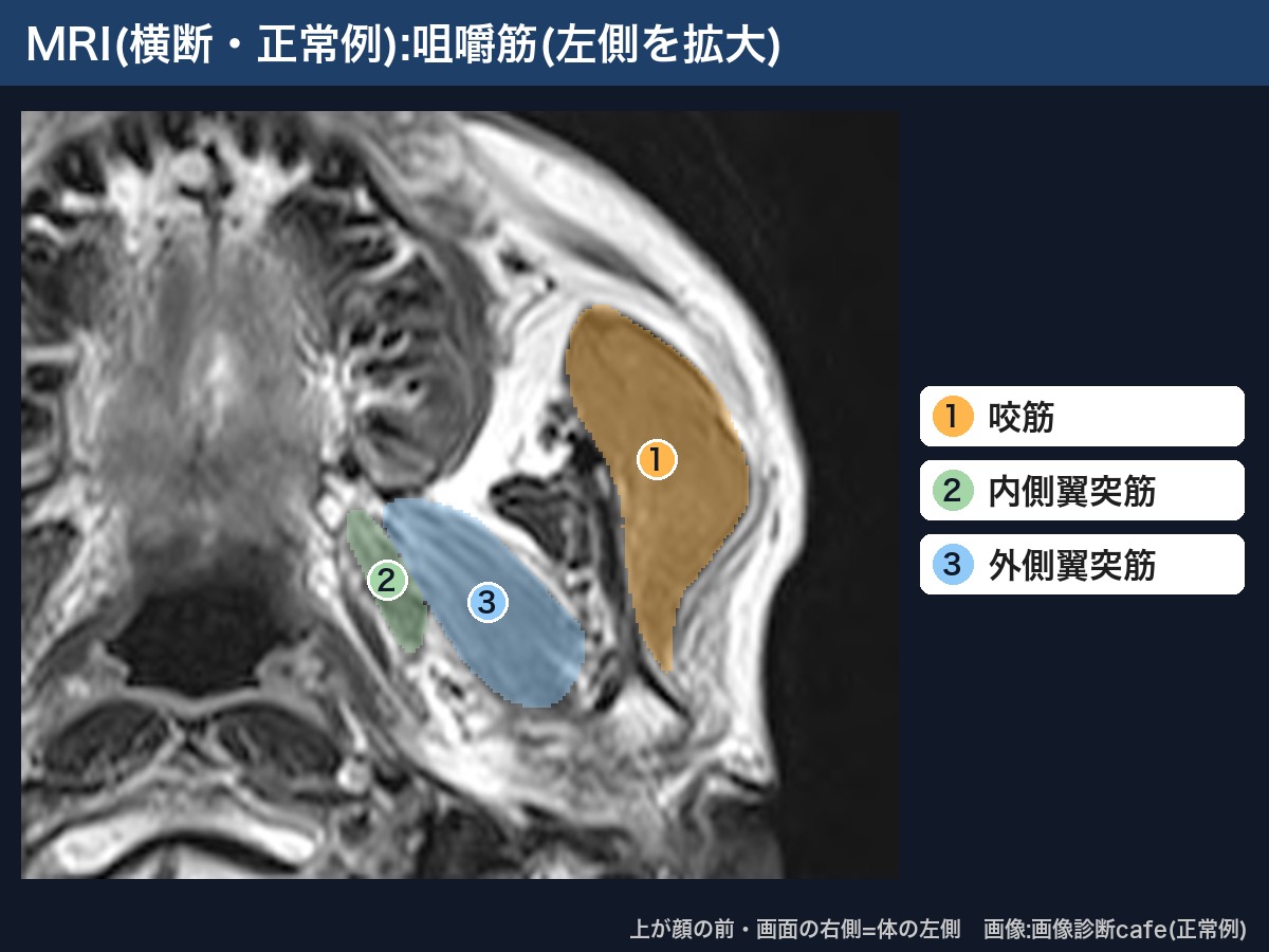 MRI(横断・画像診断cafe正常例):咀嚼筋(咬筋・内側翼突筋・外側翼突筋)