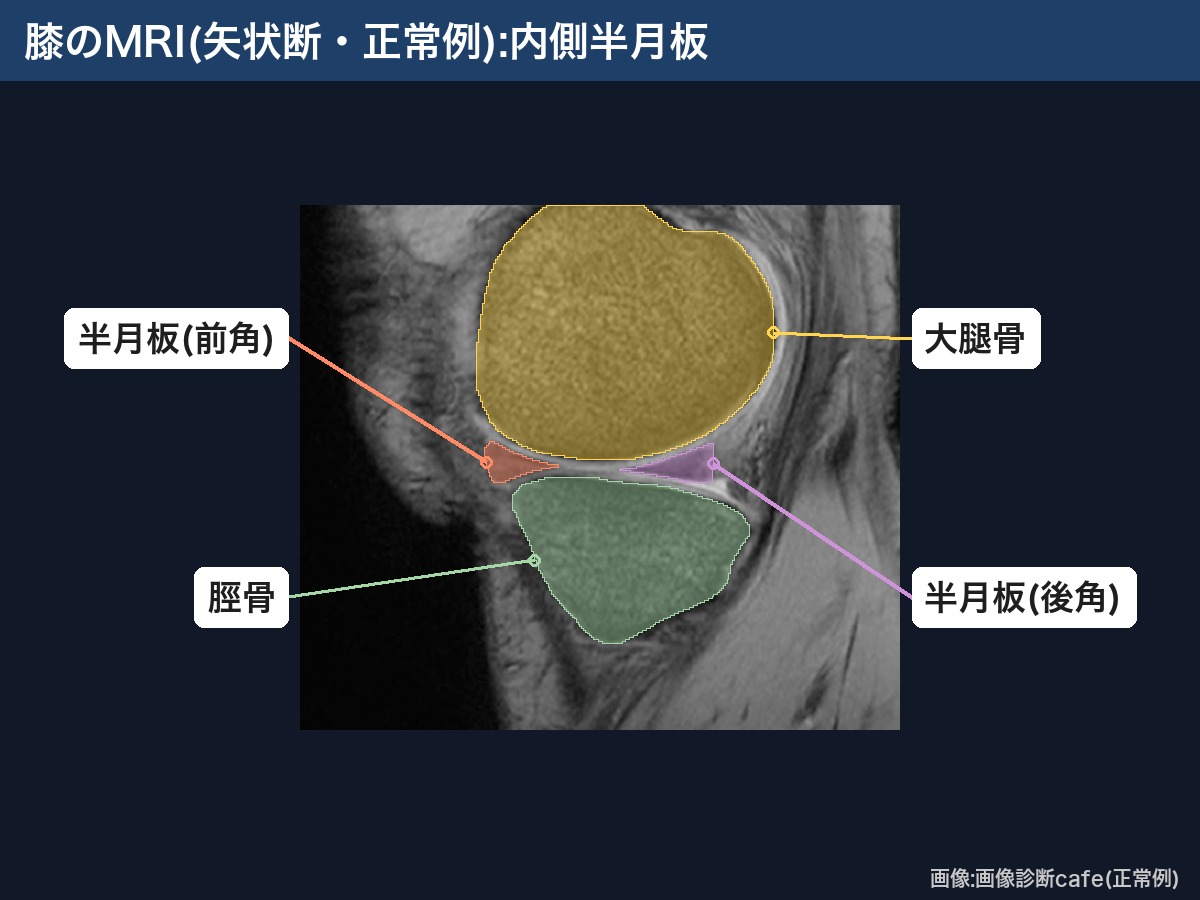 膝のMRI(矢状断・画像診断cafe正常例):内側半月板の前角と後角