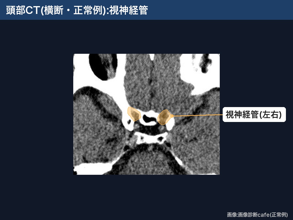 頭部CT(横断・画像診断cafe正常例):左右の視神経管