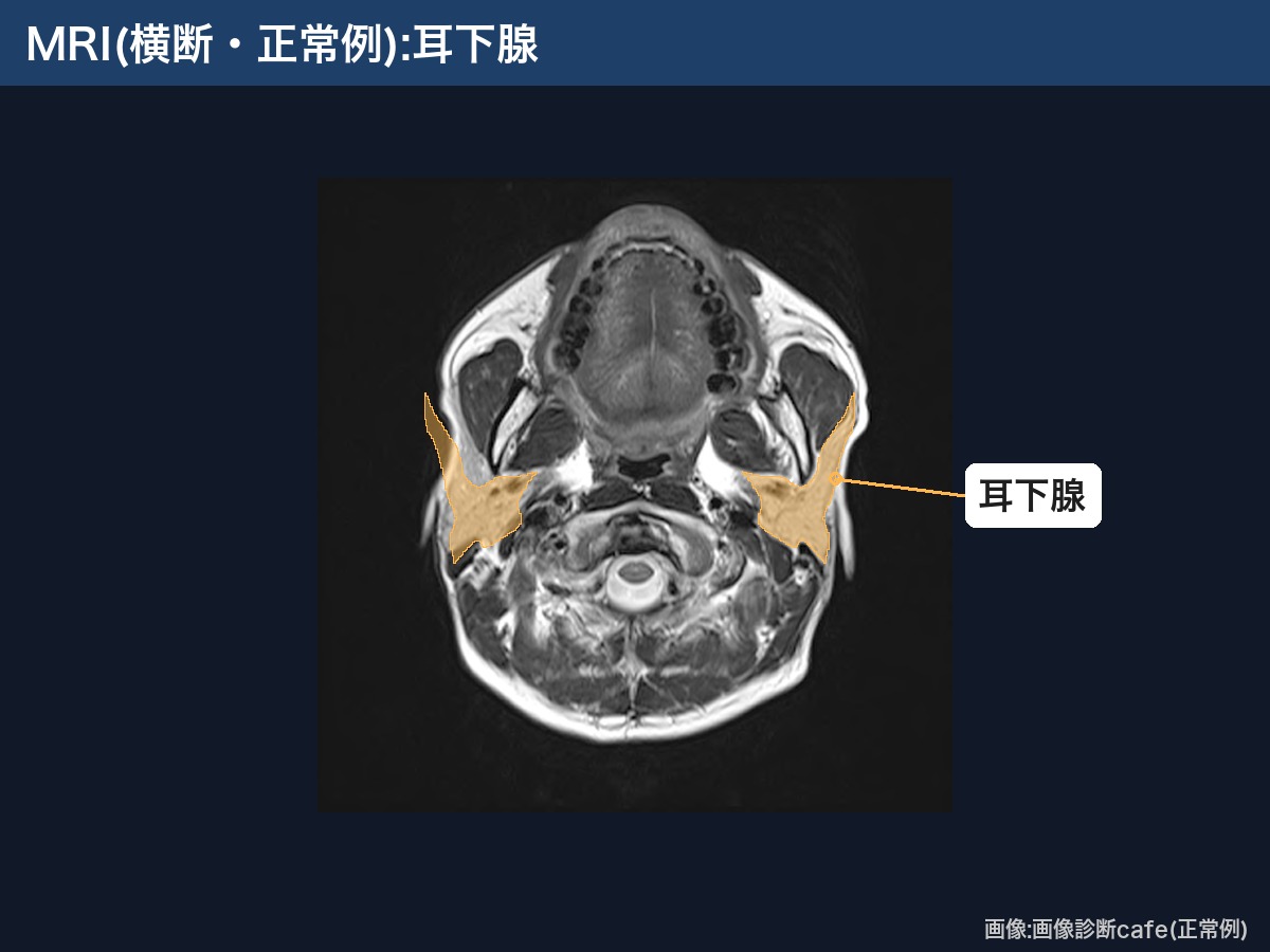 MRI(横断・画像診断cafe正常例):左右の耳下腺