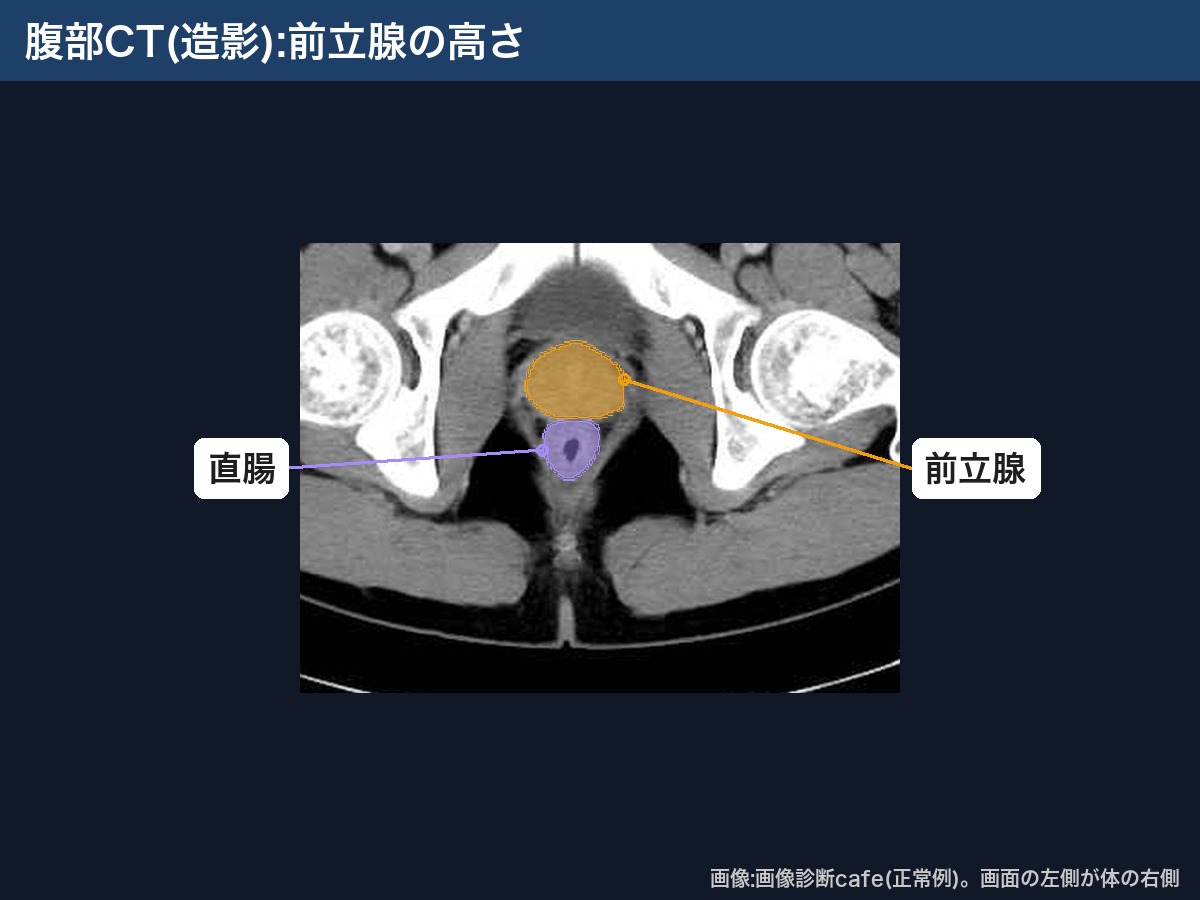 腹部CT(造影・画像診断cafe正常例):前立腺と直腸