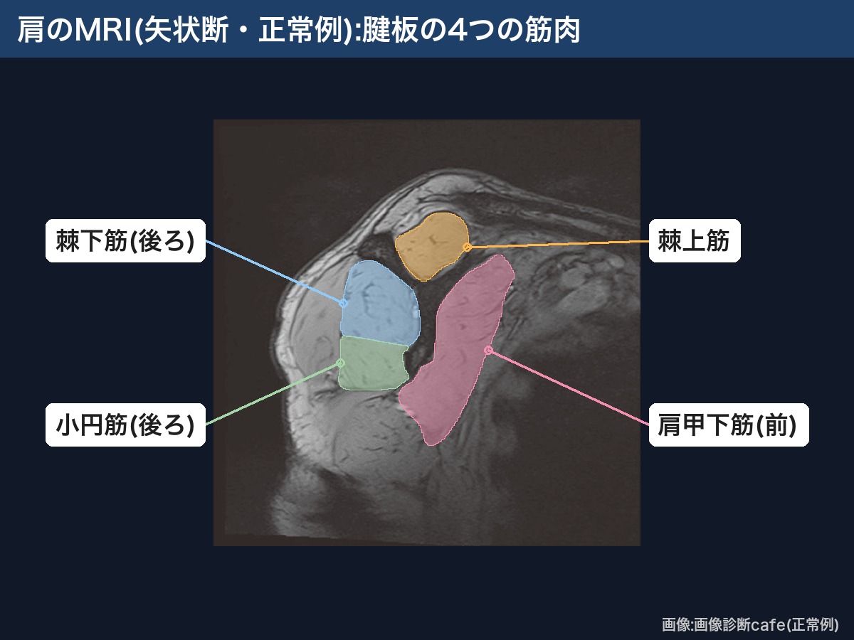 肩のMRI(矢状断・画像診断cafe正常例):腱板の4つの筋肉(棘上筋・棘下筋・小円筋・肩甲下筋)
