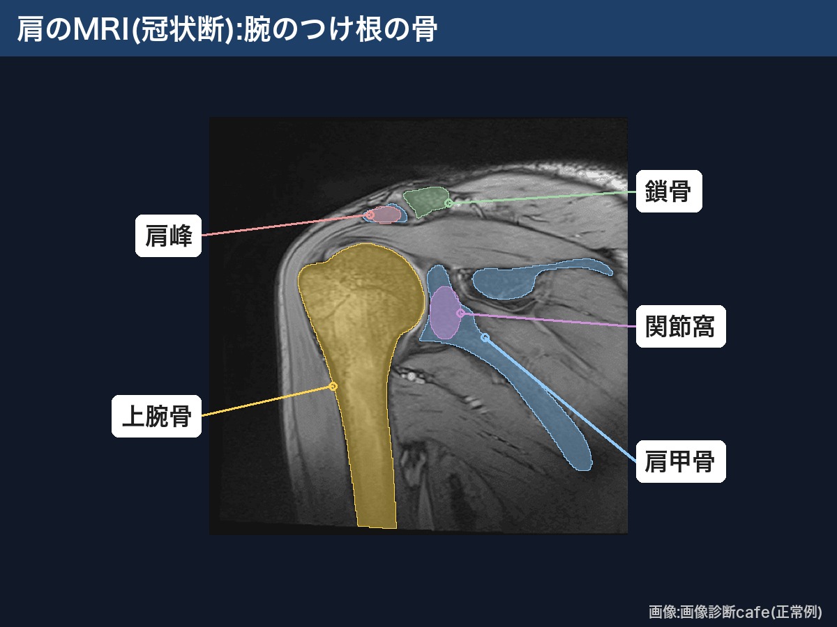 肩のMRI(冠状断・正常例):上腕骨・肩甲骨・関節窩・鎖骨・肩峰