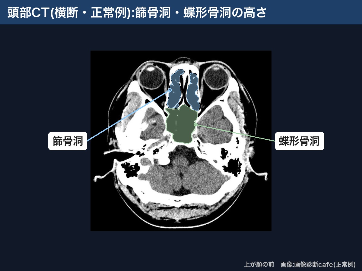 頭部CT(横断・画像診断cafe正常例):篩骨洞と蝶形骨洞