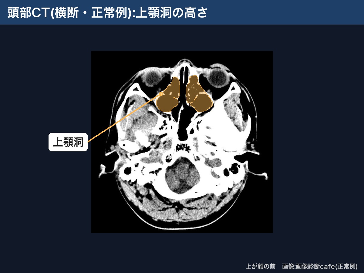 頭部CT(横断・画像診断cafe正常例):上顎洞