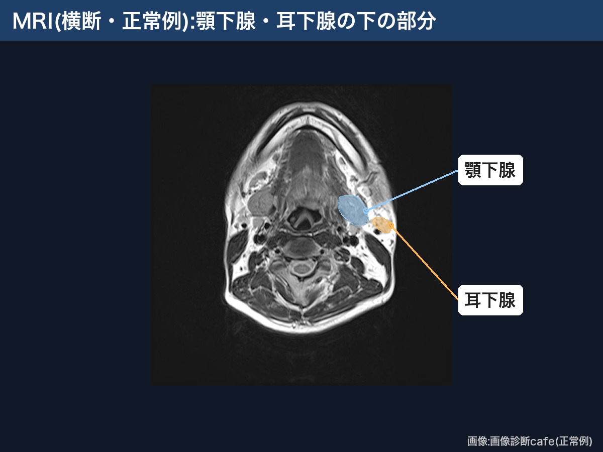 MRI(横断・画像診断cafe正常例):顎下腺と耳下腺の下の部分