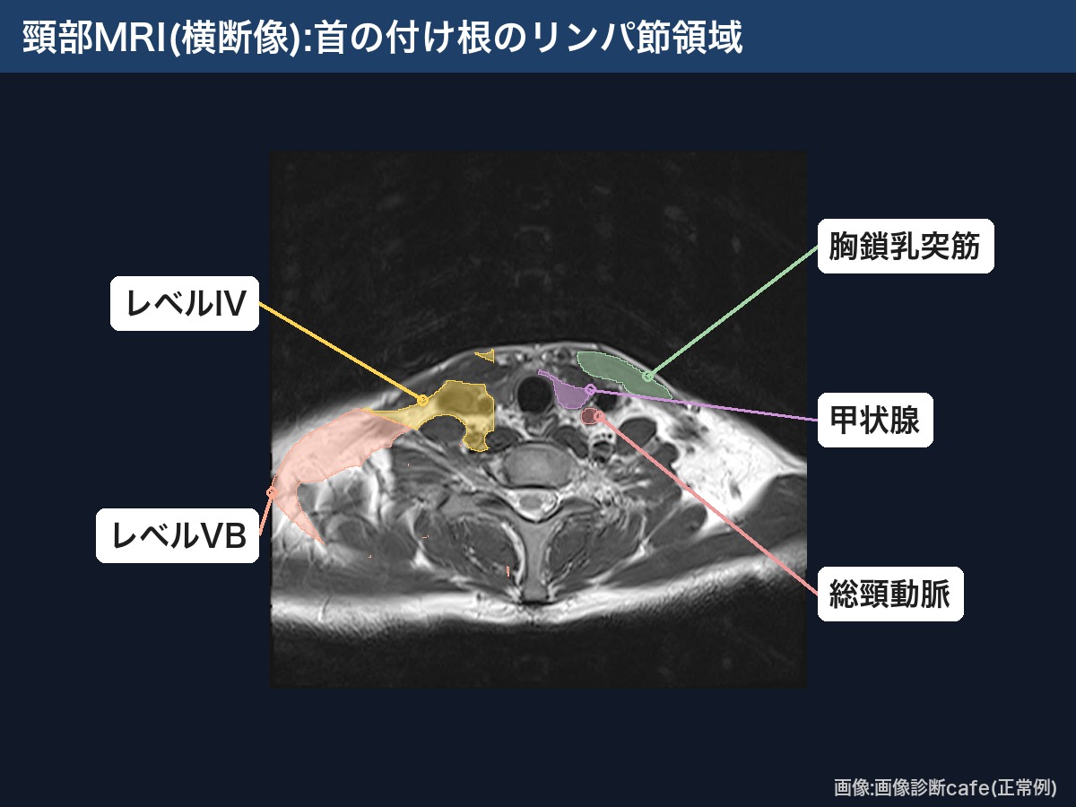 頸部MRI横断像での首の付け根のリンパ節領域(レベルIV・VB)と胸鎖乳突筋・総頸動脈・甲状腺
